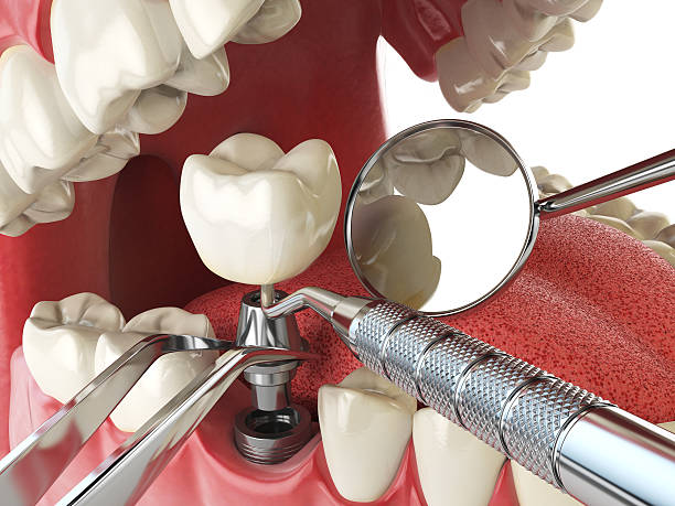 Best Emergency Root Canal Treatment in Pacific, WA